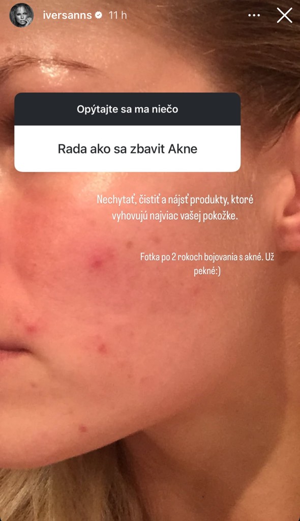 ivana gaborikova plet akne